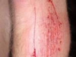 making your self bleed without pain