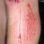 making your self bleed without pain