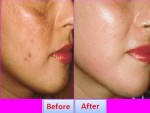 Age Spots On Face