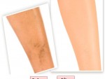 Get Rid Of a Bruise