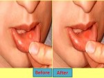 Canker Sore