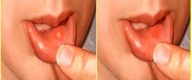 Canker Sore