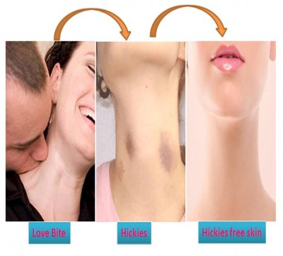 hickey kiss