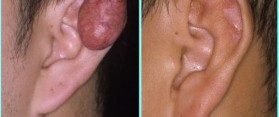 Keloid