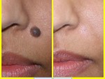 Get Rid Of a Mole without Surgery