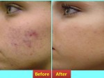 Get Rid Of a Pimple