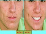 Rash after Shaving