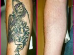 Get Rid Of a Tattoo