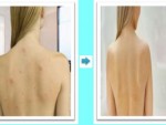 Get Rid of back acne