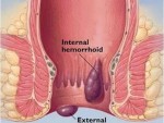 External and Internal Hemorrhoid