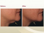 Getting Rid of Double Chin