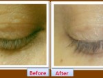 Get Rid Of a Skin Tag