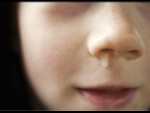 Runny Nose
