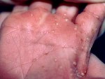 Yeast Infection