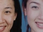 acne scars before and after