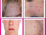 get rid of Blemishes