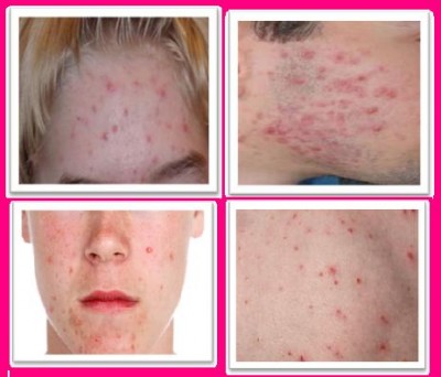 How to Get Rid Of Blemishes Overnight get rid of Blemishes
