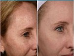 get rid of Brown Spots on Face