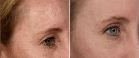 get rid of Brown Spots on Face