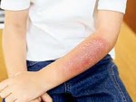 Burn Scar