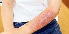 Burn Scar