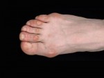 Corn on toes