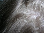 Dry Scalp Flakes