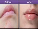 before and after flat warts