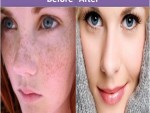 Get Rid Of Black Spots