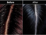 Get Rid Of Dandruff