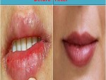 Dry Mouth