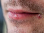 Treating Cold Sores Naturally at Home
