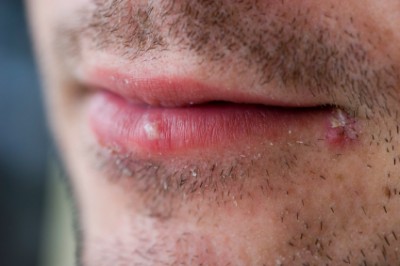 Treating Cold Sores Naturally at Home