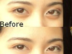 How to get rid of eye balls