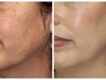 Microdermabrasion Before And After