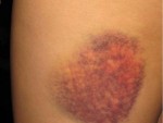 Treating Bruises