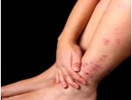 how to get rid of eczema