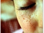 how to get rid of freckles naturally