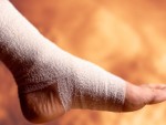 Treating a Sprained Ankle