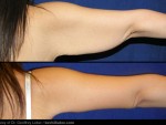 ARM-LIFT-SURGERY-BRACHIOPLASTY