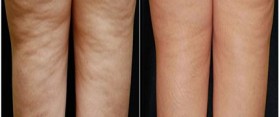 Cellulite