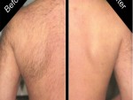 Gettong Rid of Back Hairs