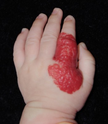 How to Get Rid Of Birthmarks Without Surgery How to Get Rid Of Birthmarks Without Surgery