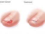 Ingrown toenail
