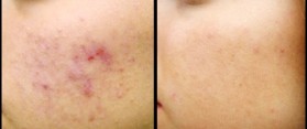 how to get rid of chicken pox scars
