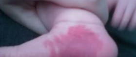 birthmarks