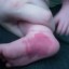 birthmarks