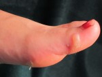 blister001