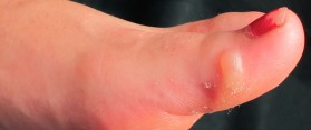 blister001
