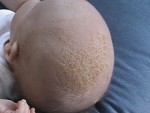 cradle caps